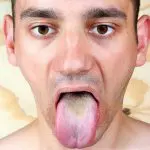 Bruine tong: symptomen, oorzaken en behandeling