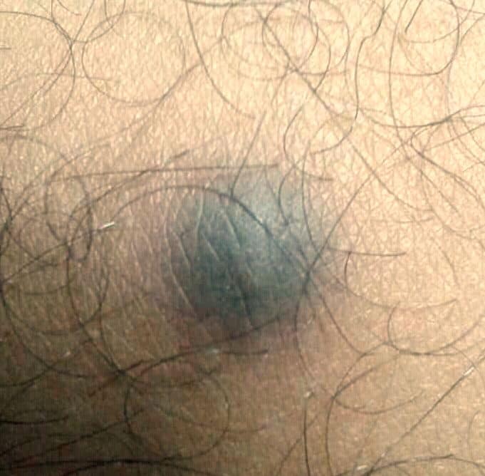 Close-up van een huidafwijking op een behaard huidoppervlak, zichtbaar als een blauwgrijs, rond en licht verzonken knobbeltje. Dit is kenmerkend voor een dermatofibroom – een goedaardige, vaak pijnloze huidverharding die meestal voorkomt op benen of armen. De huid eromheen oogt verder normaal.