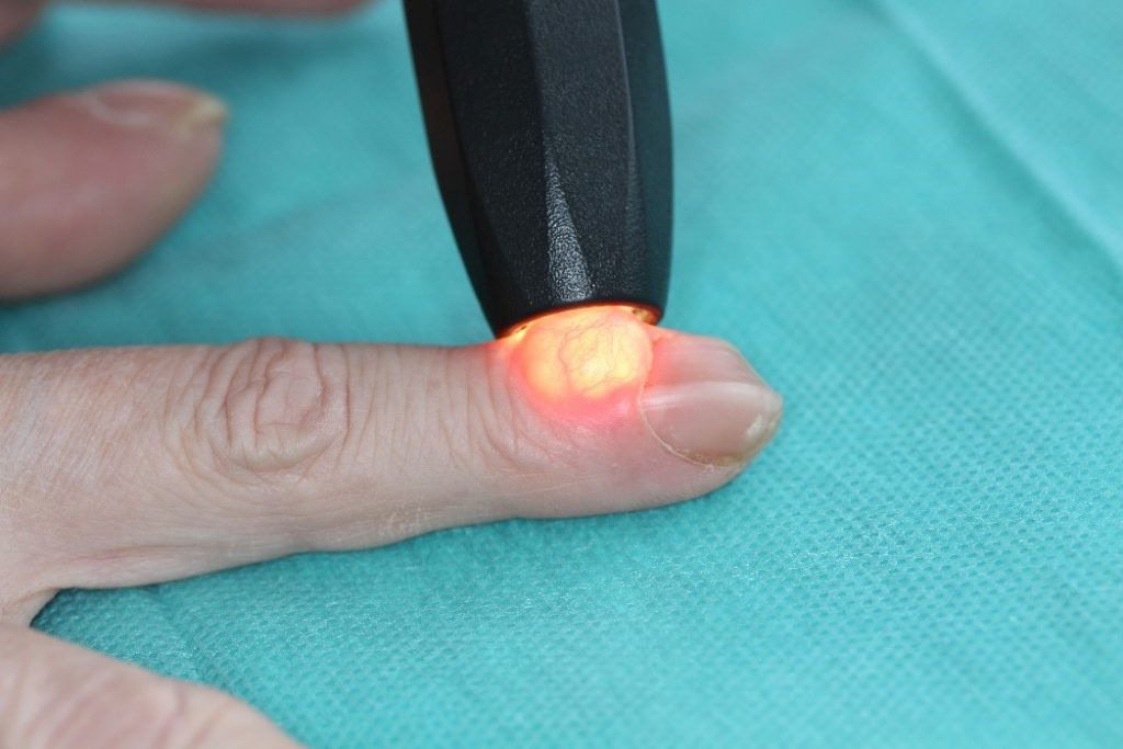Illustratie van de transluminescentie van een mucoïd cyste met inkeping van de nagel