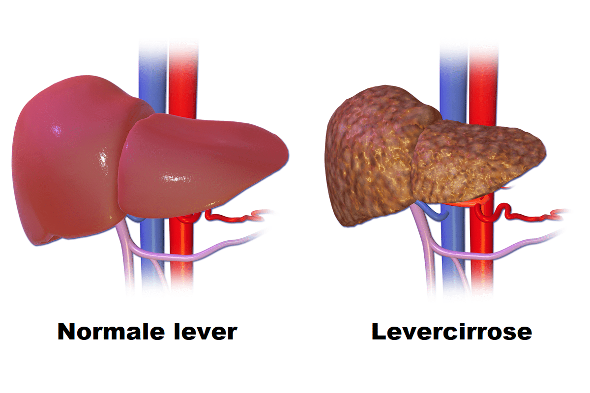 Normale lever en levercirrose