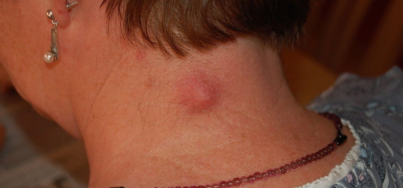 Talgkliercyste in de nek