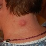 Knobbeltje in nek: oorzaken van bultje in nek