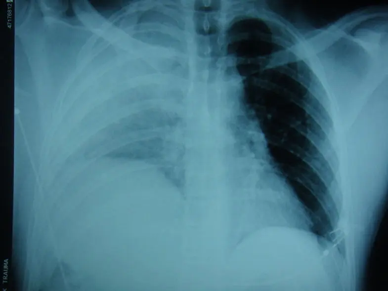 Een röntgenfoto met rechts een verhoogd diafragma