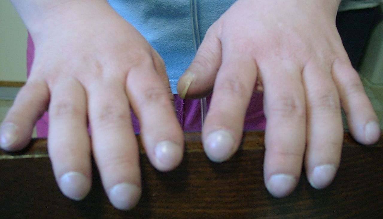 Trommelstokvingers bij een patiënt met het syndroom van Eisenmenger