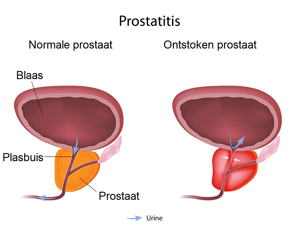 Prostaatontsteking