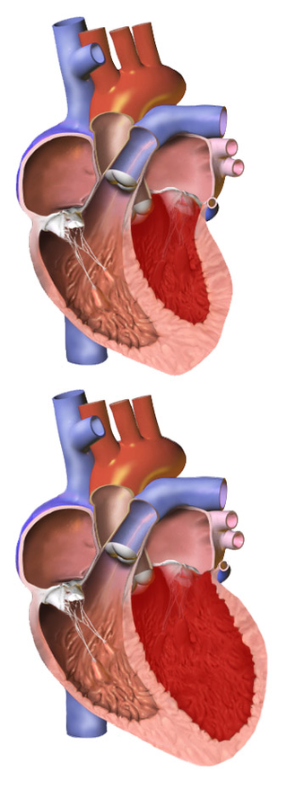 Normaal hart versus vergroot hart