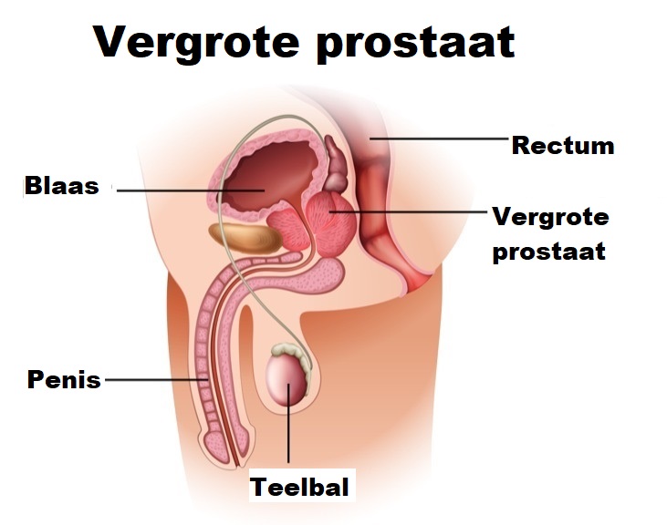 Vergrote prostaat