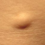 Knobbel onder huid: oorzaken onderhuids bultje