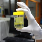 Schuimende urine: oorzaken van schuim op plas