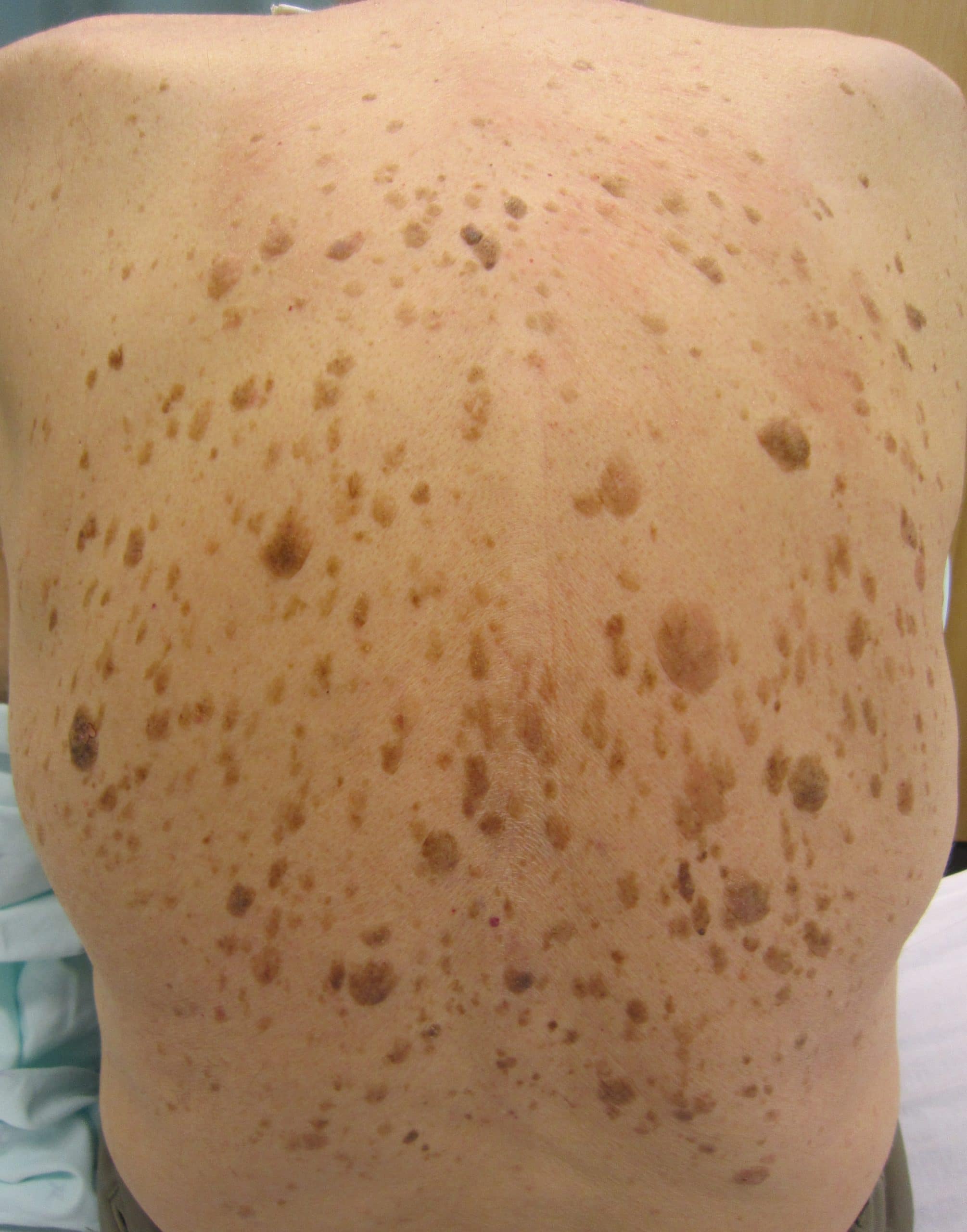 Veel seborroïsche keratosen op de rug van een persoon met het teken van Leser-Trélat als gevolg van darmkanker