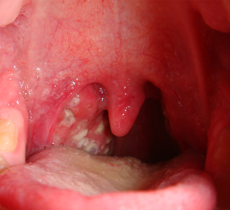 Ontstoken keelamandelen of tonsillitis