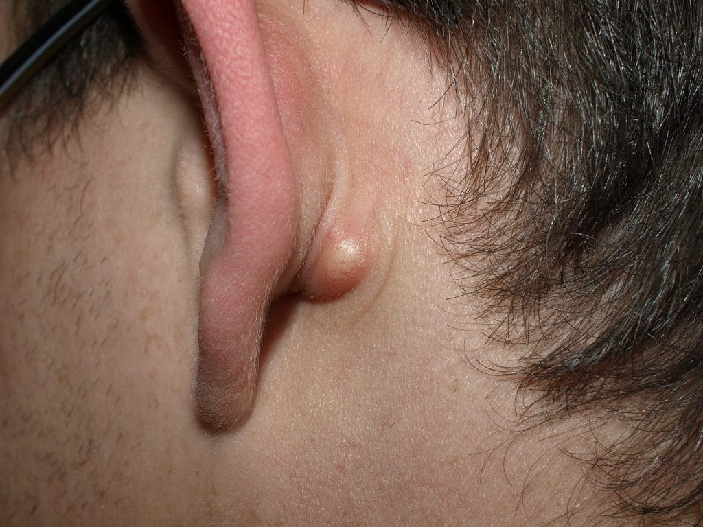 Talgkliercyste achter her oor