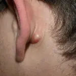 Knobbeltje achter het oor: oorzaken bultje achter oor