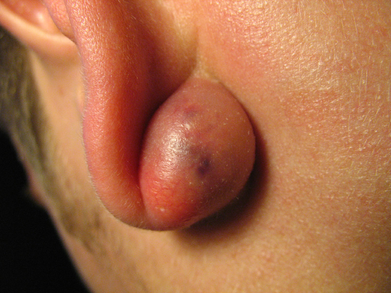 Talgkliercyste achter het oor