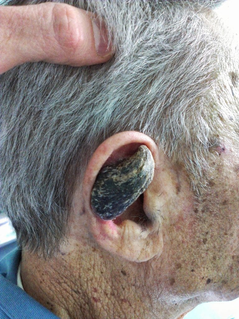Cornu cutaneum (huidhoorn) symptomen en behandeling Mens & Gezondheid