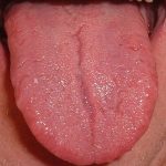 Tintelende tong: oorzaken van prikkelende tong
