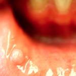 Bijtfibroom op tong, wang of lip verwijderen