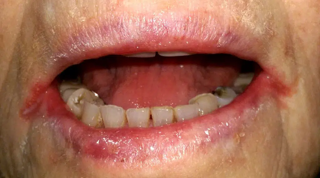 Bilaterale cheilitis angularis bij een oudere persoon met bloedarmoede door ijzertekort en een droge mond / Bron: Wikimedia Commons