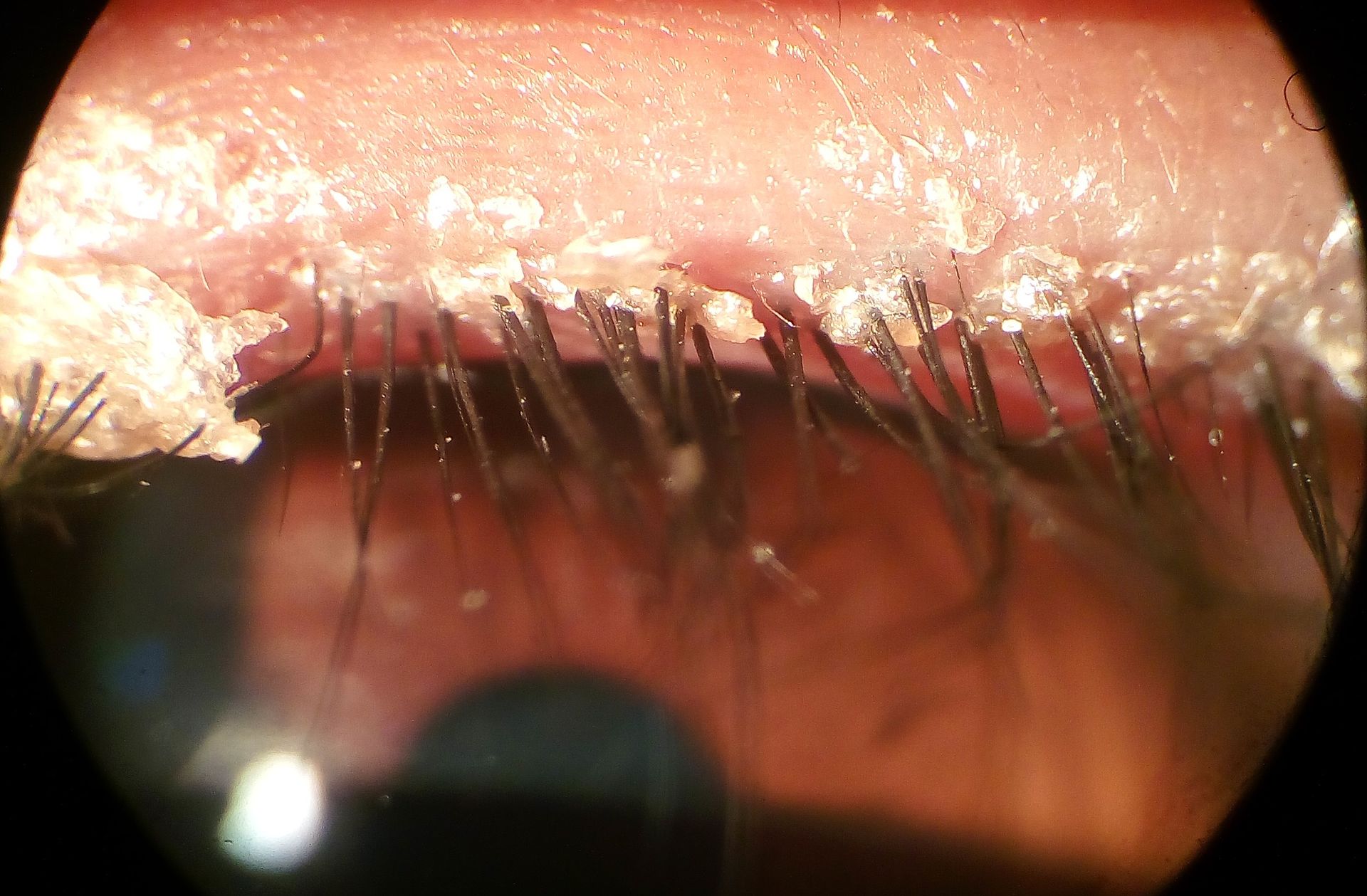 Anterieure ooglidrandontsteking of blefaritis / Bron: Wikimedia Commons