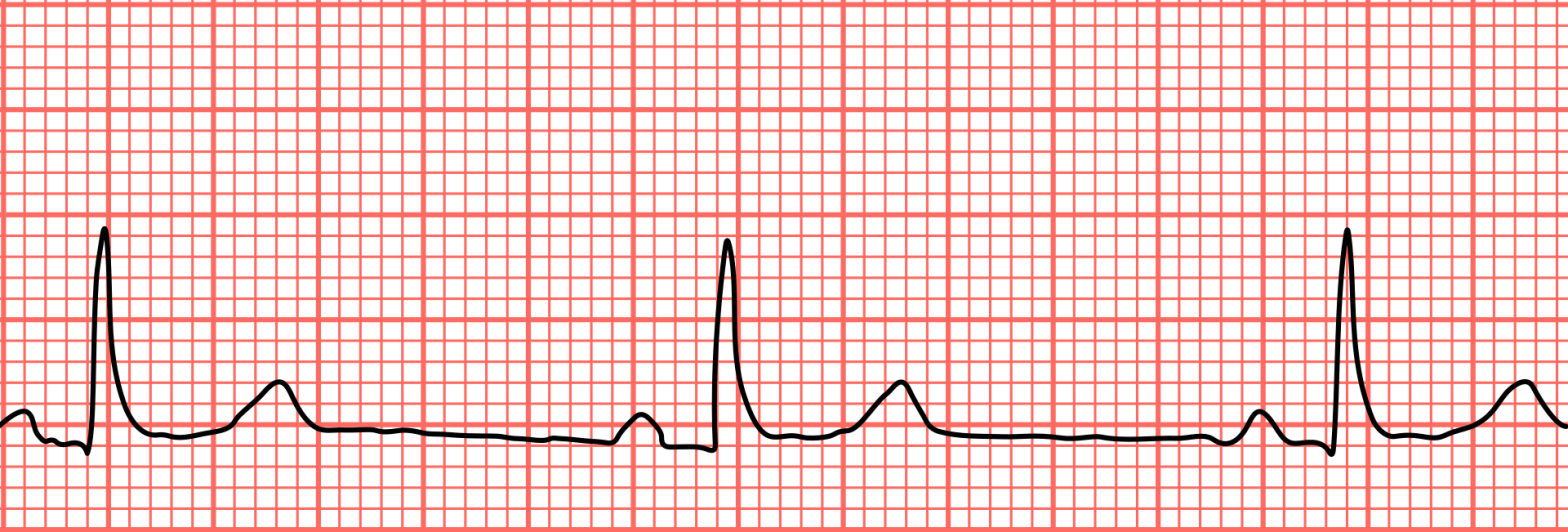 Bradycardie: hartslag die onder het normale bereik ligt