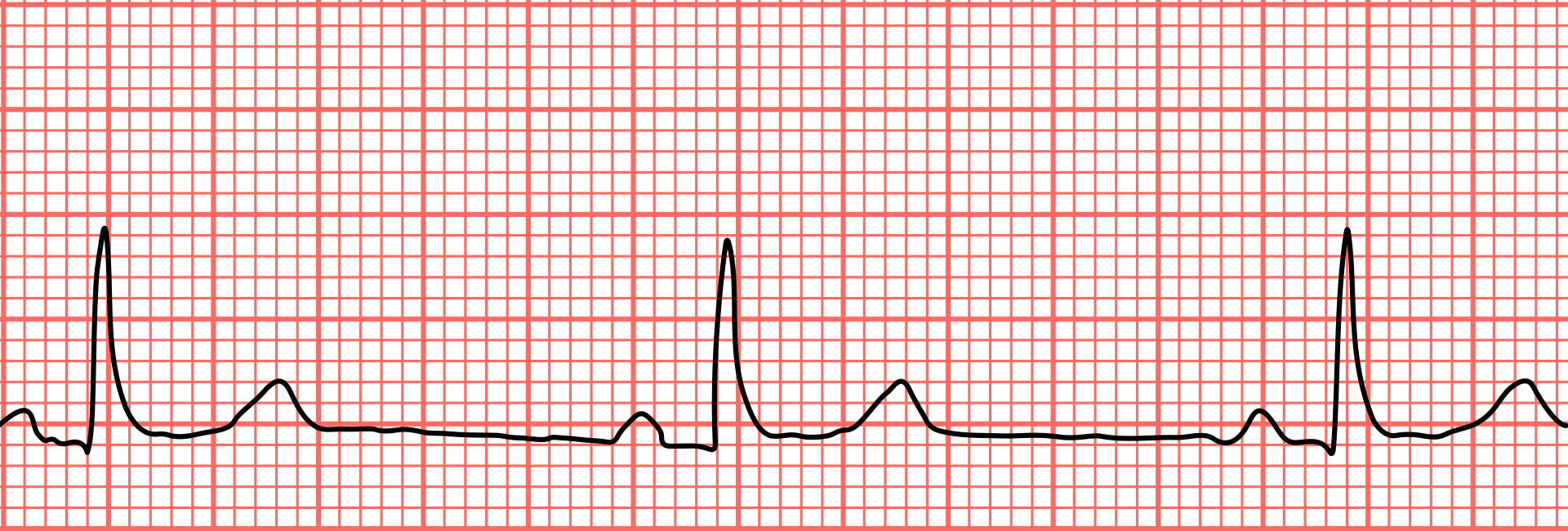 Bradycardie: hartslag die onder het normale bereik ligt