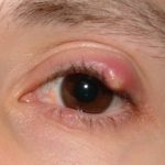 Bultje op ooglid: symptomen en oorzaken