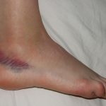 Gekneusde voet: symptomen en behandeling