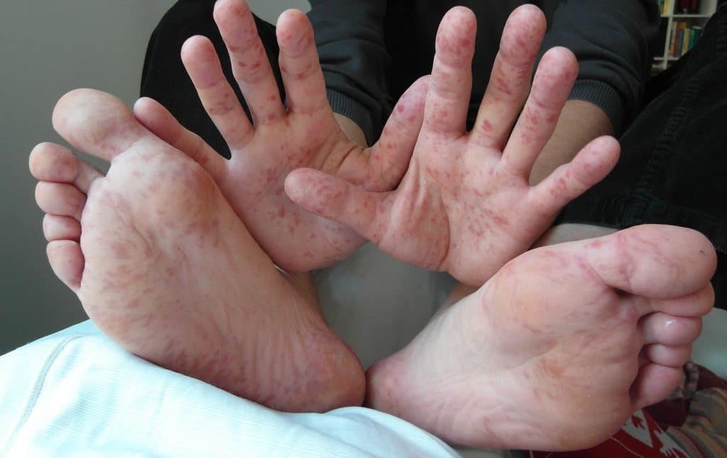 Hand-, voet- en mondziekte bij een volwassenen (36 jaar) / Bron: Wikimedia Commons