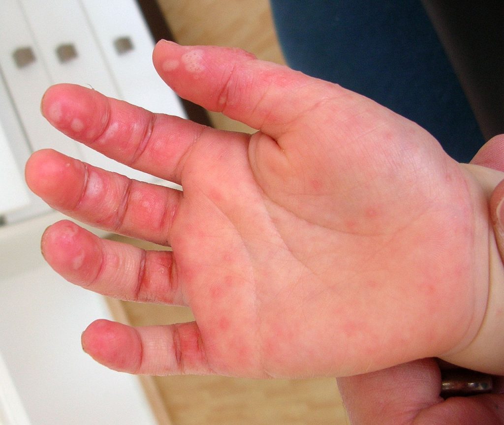 Hand-, voet- en mondziekte op de hand van een kind / Bron: Wikimedia Commons