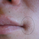 Kapotte mondhoeken: oorzaken en behandeling cheilitis angularis