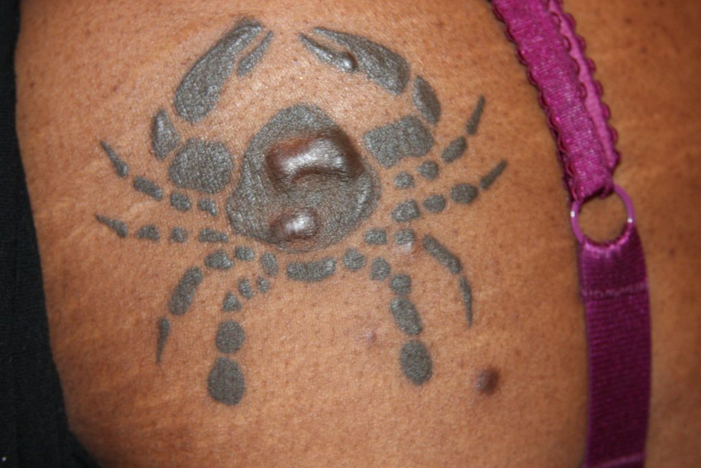 Keloïd op een tatoeage / Bron: Wikimedia Commons
