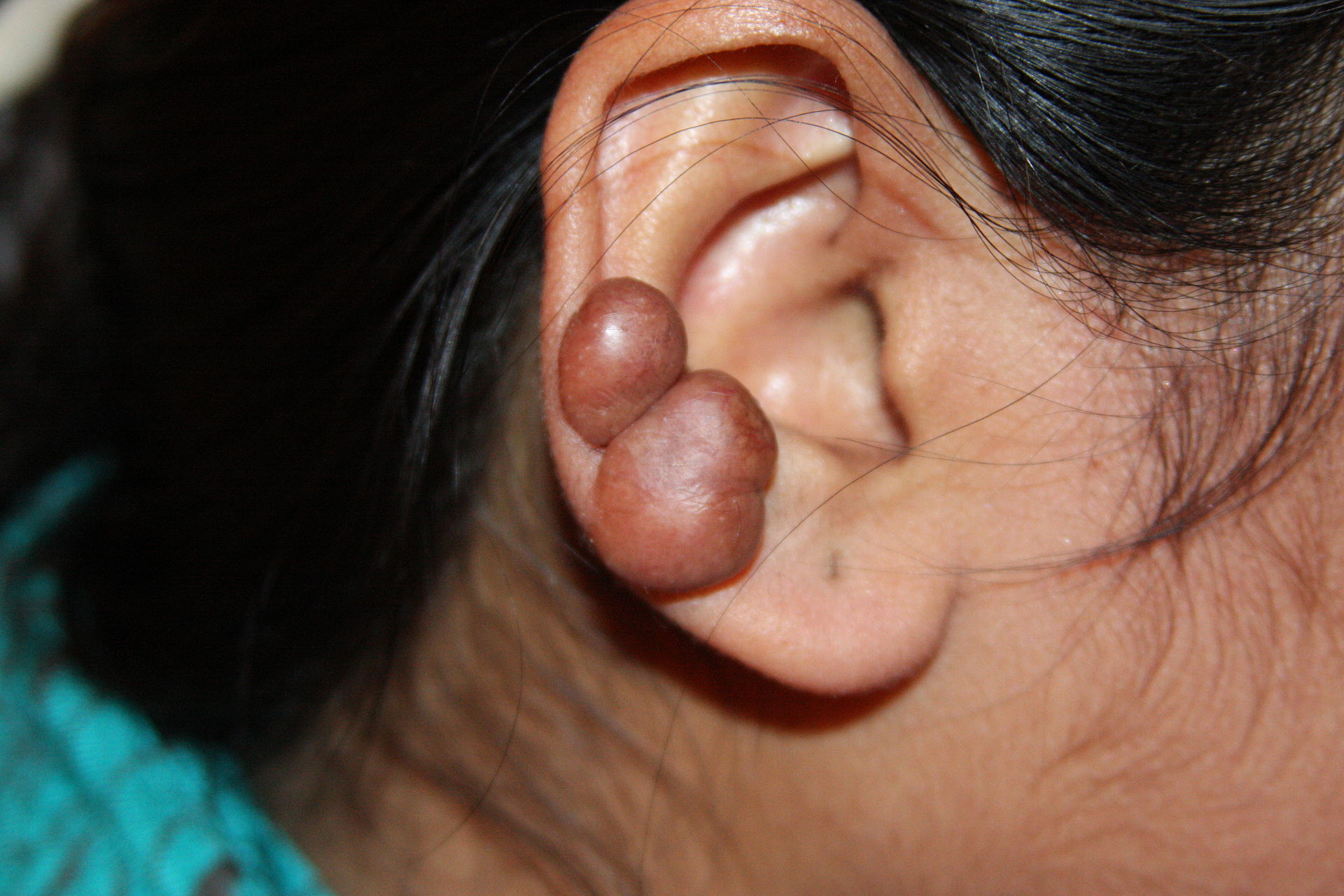 Keloïd op het oor / Bron: Wikimedia Commons