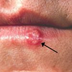 Bultje op de lip: oorzaken van een lipknobbeltje