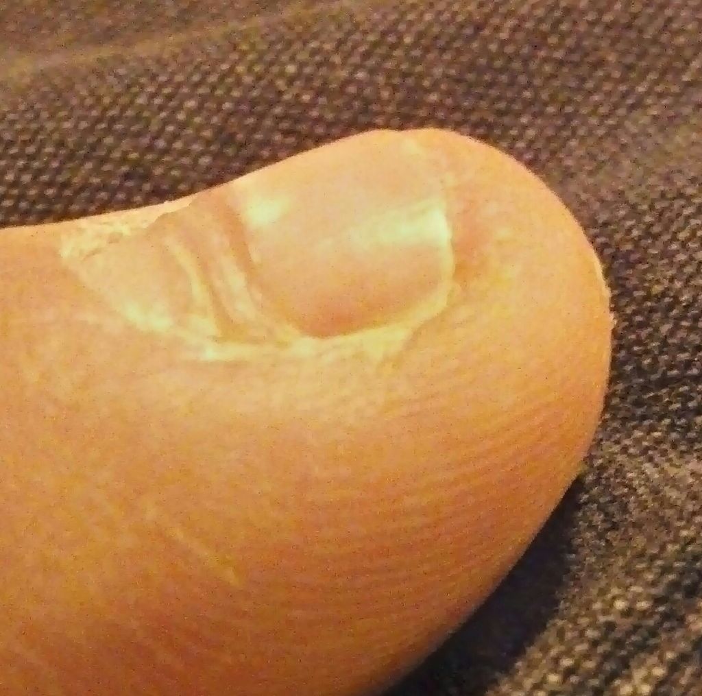 Lijnen van beau op de nagel van de linker middelvinger / Bron: Wikimedia Commons