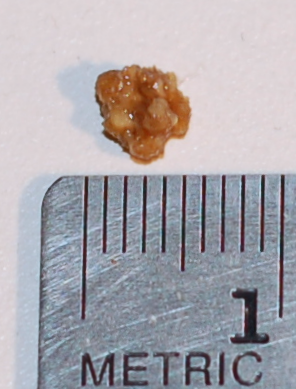 Niersteen van 5 mm