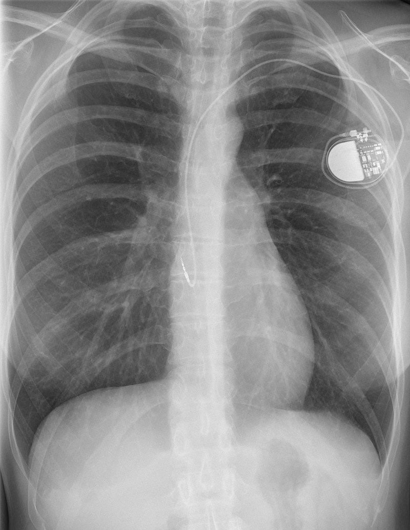 Röntgenfoto van een pacemaker