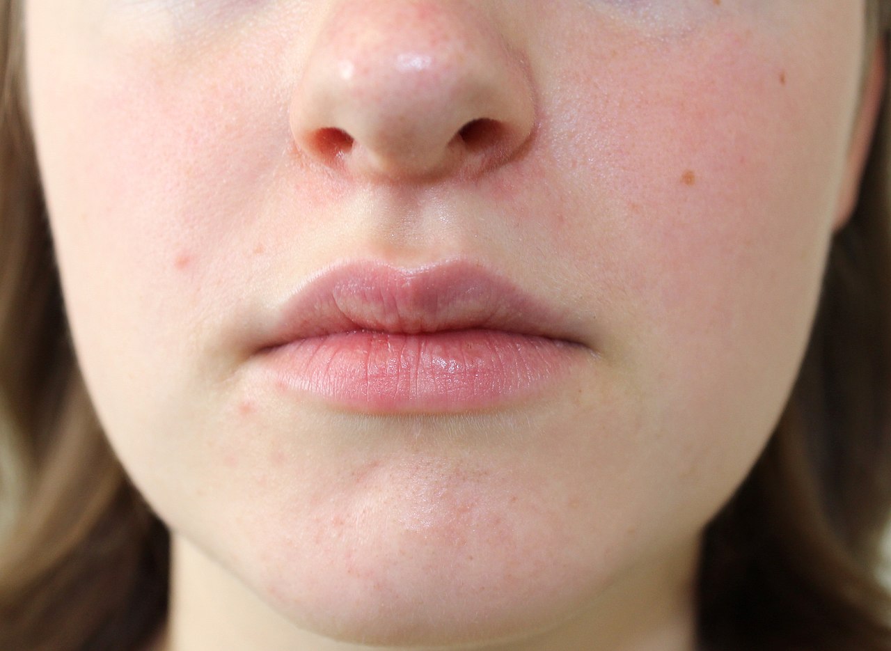 Typische symptomen van milde periorale dermatitis (clownseczeem): uitgebreid erytheem (rood worden), inflammatoire papels (knobbeltjes) en periorale bleekheid
