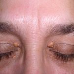 Gele bultjes bij ogen door xanthelasma palpebrarum