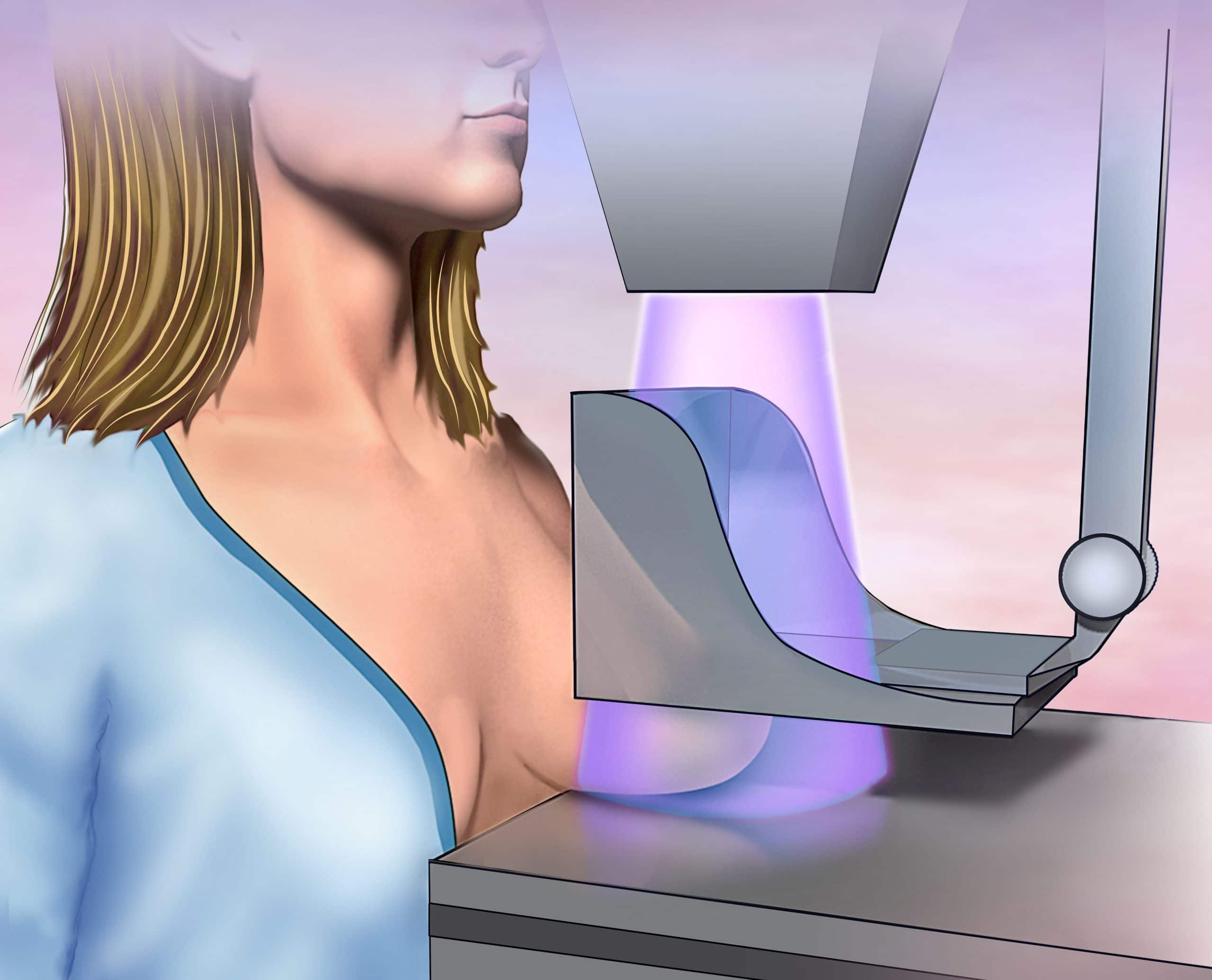 De afbeelding toont een schematische illustratie van een mammografieonderzoek.Doel van het onderzoek: Een mammogram is een röntgenfoto van de borst die wordt gebruikt om afwijkingen, zoals borstkanker, in een vroeg stadium op te sporen.Werkwijze: Tijdens het onderzoek wordt de borst samengedrukt tussen twee platen van het röntgenapparaat.Frequentie: In Nederland worden vrouwen tussen 50 en 75 jaar elke twee jaar uitgenodigd voor een bevolkingsonderzoek.