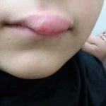 Gezwollen lip door angio-oedeem