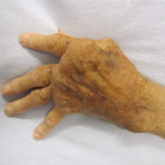 Reumatoïde artritis / Bron: Wikimedia Commons