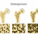 Osteoporose (botontkalking): symptomen en behandeling