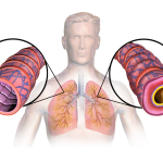 Astma: symptomen, oorzaak en behandeling