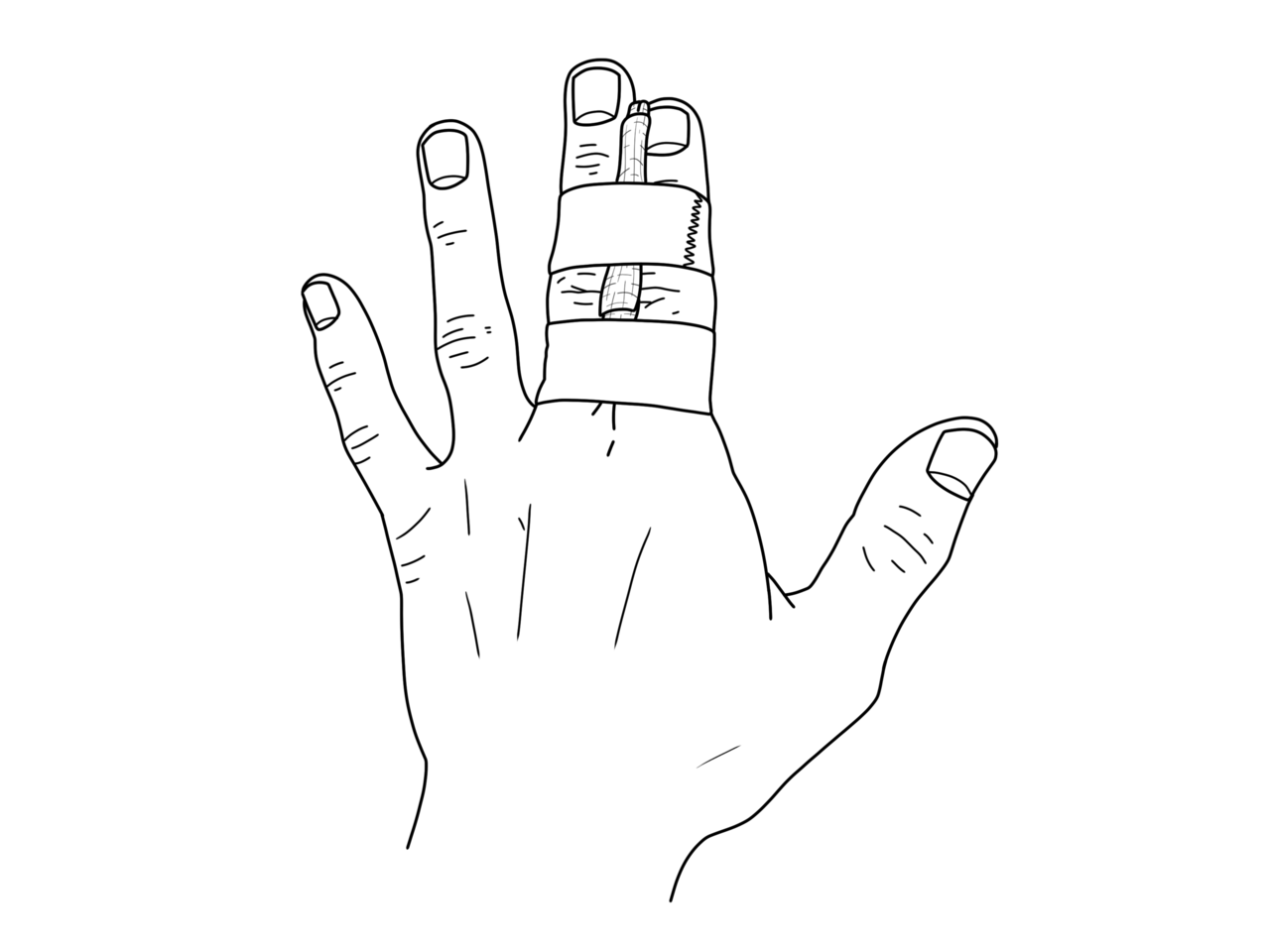 Buddytaping van een gebroken vinger