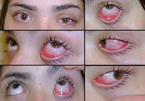 Conjuntivitis (rood oog)