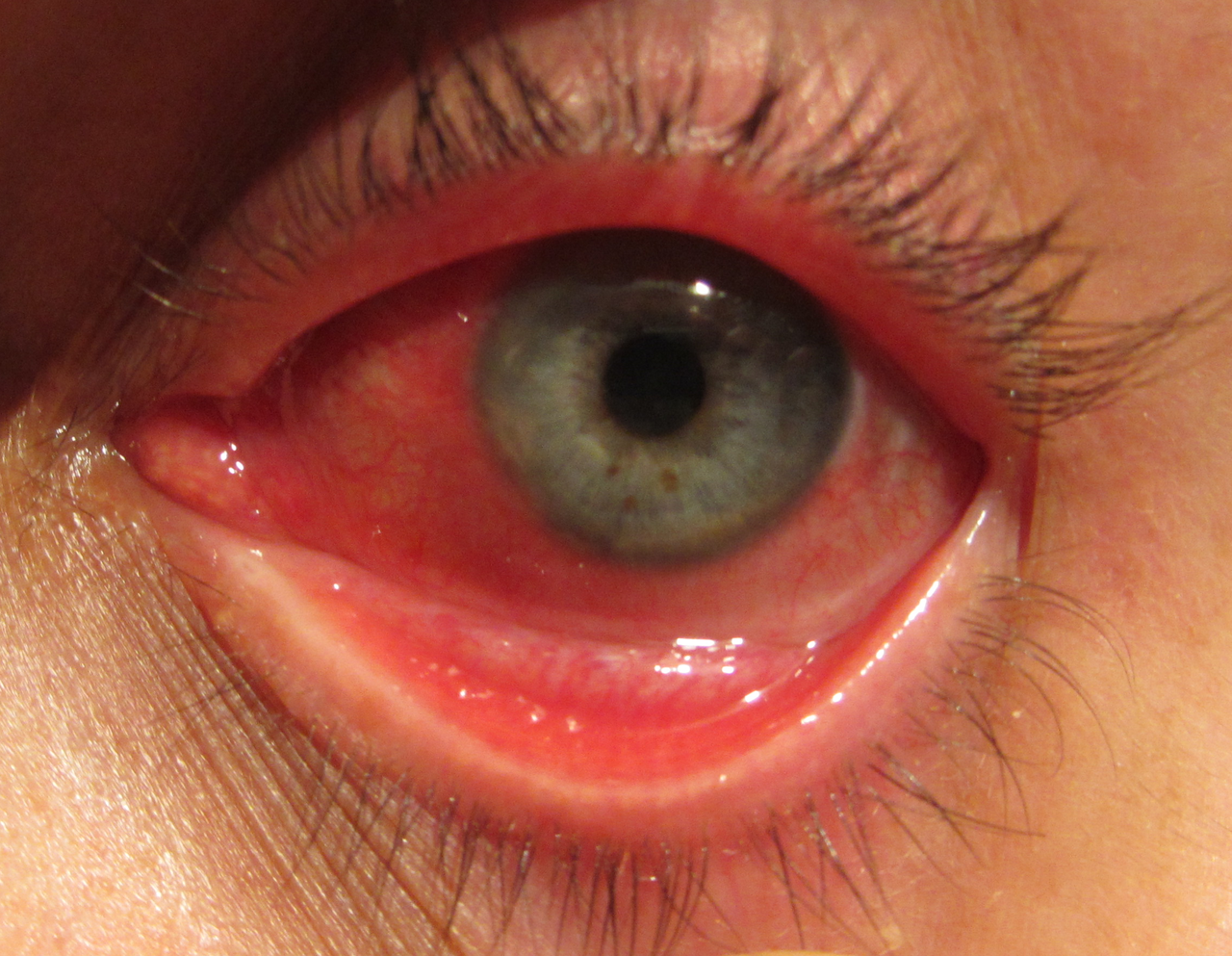 Conjuntivitis (rood oog)
