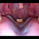 Epiglottitis: symptomen, oorzaak en behandeling