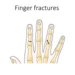 Gebroken vinger: symptomen, oorzaken en behandeling