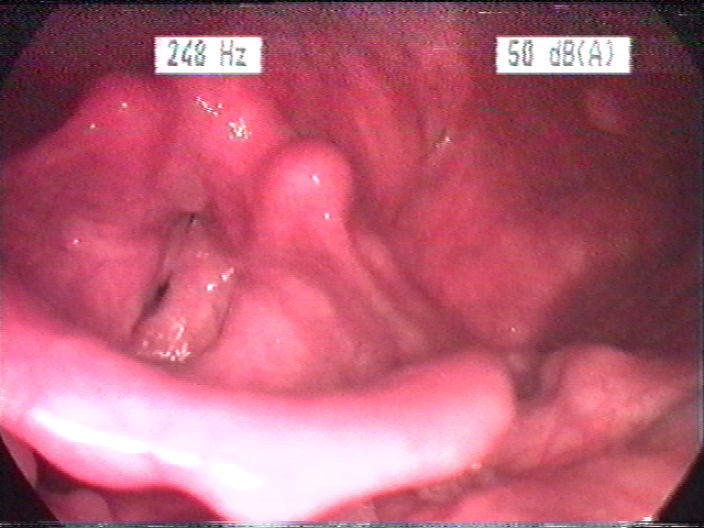 Chronische laryngitis