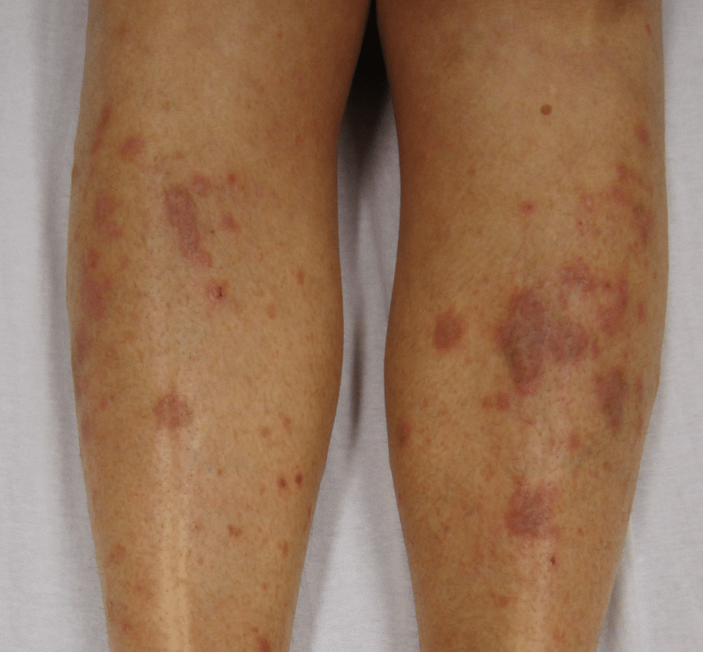 Lichen planus: symptomen, oorzaak en behandeling